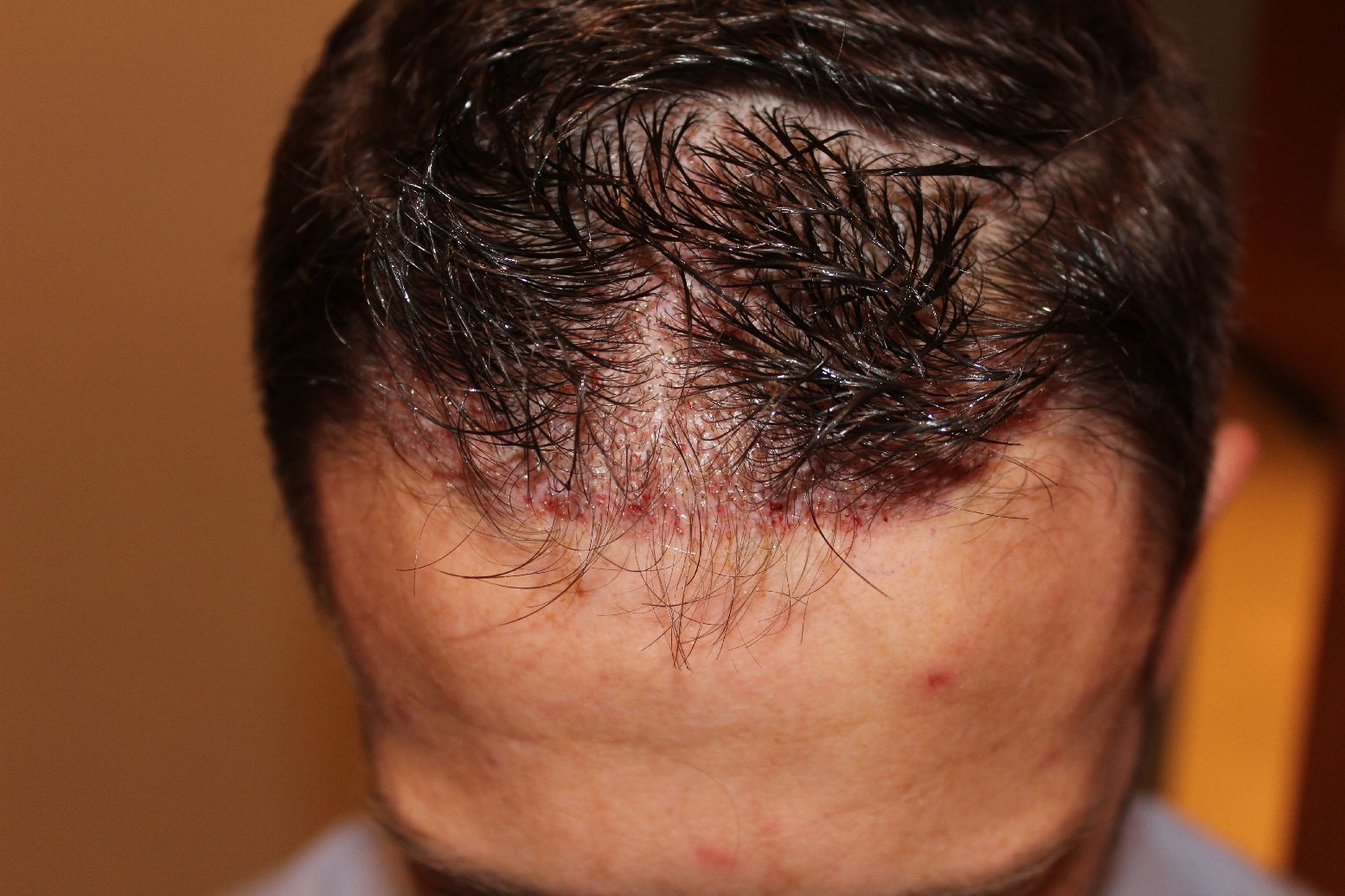 FUE Haartransplantation ohne Rasur der Empfangszone